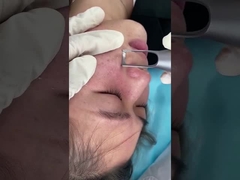 1064nm 532nm صالون بيكو ثانية آلة الليزر لعلاج مشاكل تصبغ الجلد