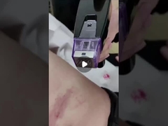 50 واطة ميكرو إبرة RF جزئية 100 فولت إلى 240 فولت